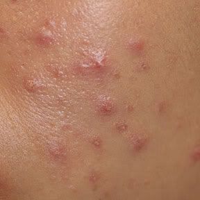 Herpes Pimple Pictures